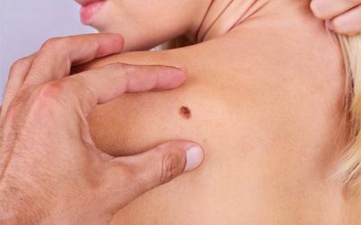 Common concerns about skin cancer