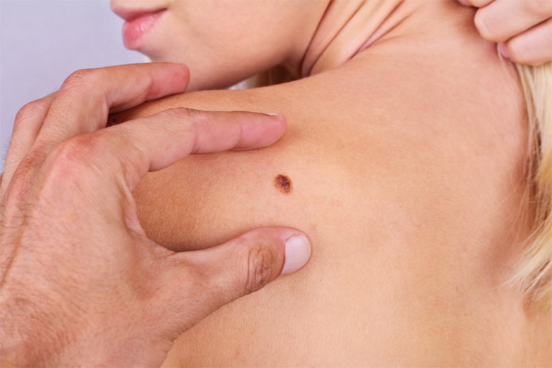 Common concerns about skin cancer