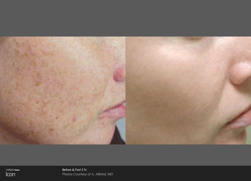 IPL Facial / Photofacial Sarasota Before and After Photos