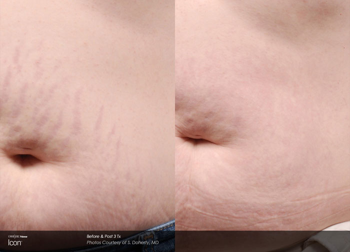 Scar Treatment Before & After3