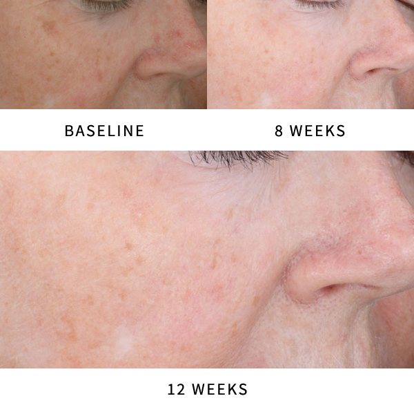 Actinic Keratosis Before & After