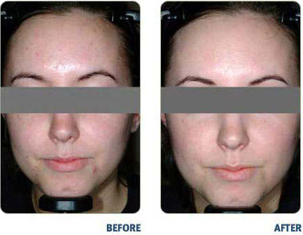 BLU-U-For Acne Before & After1