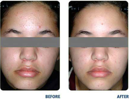 BLU-U-For Acne Before & After2