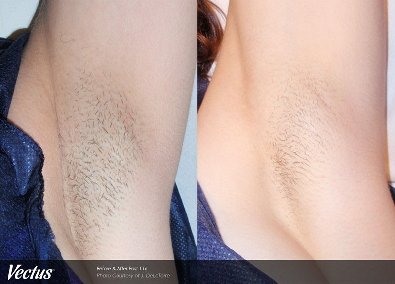 Laser Hair Removal Before & After1