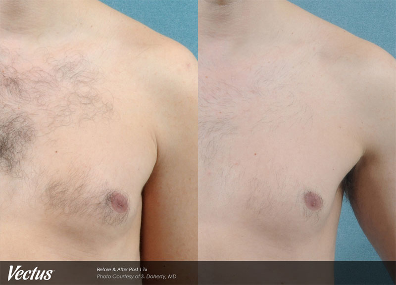 Laser Hair Removal Before & After2