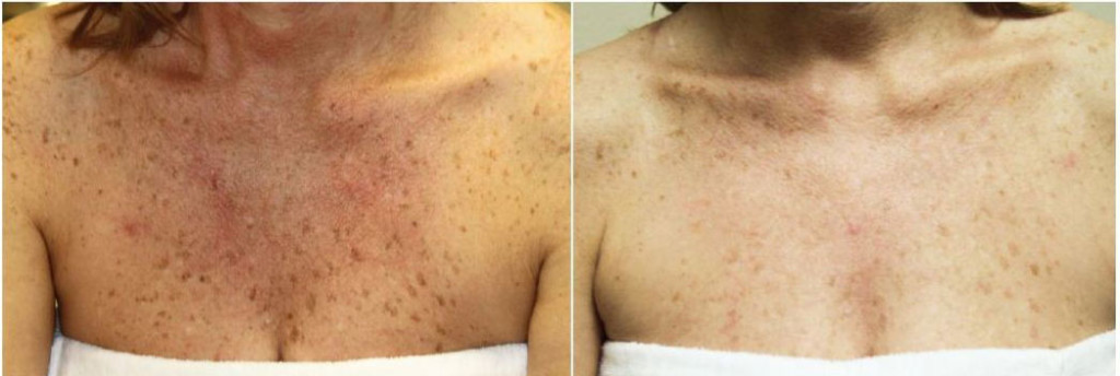 Before And After Acne1