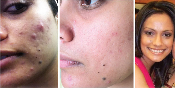 Before And After Acne