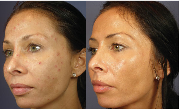 Before And After Acne2