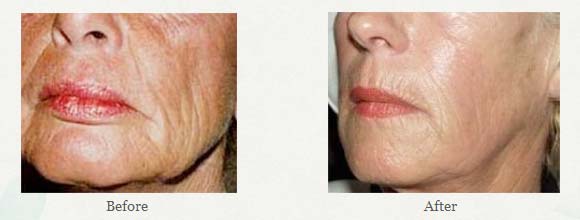 What is Sculptra