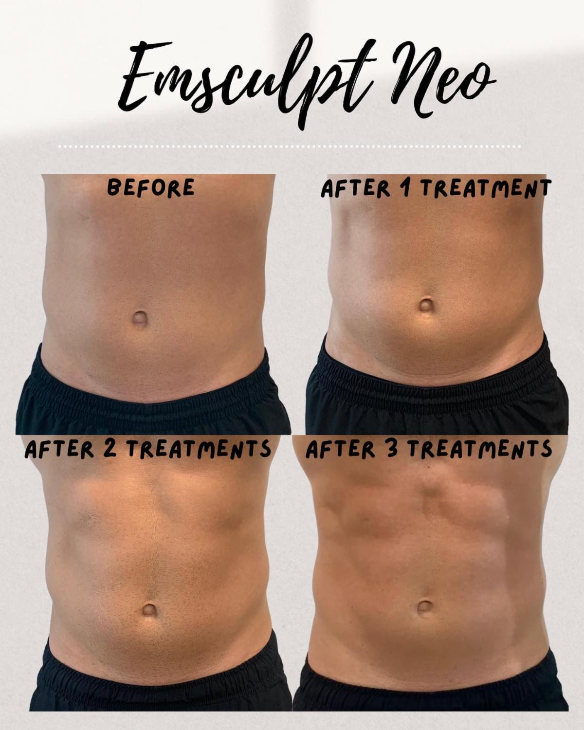 Emsculpt NEO Before and After