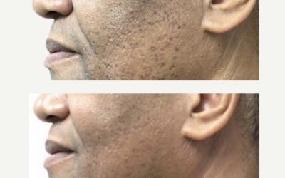 Amazing Results After 3 Treatments Of The SkinPen Microneedling